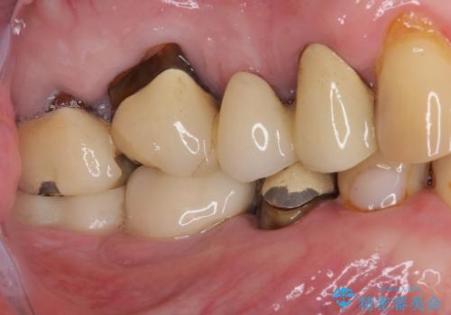 かけて金属の見えてしまったセラミック 強化セラミックでの補綴治療の治療前