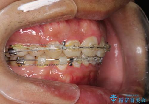ワイヤー矯正終了時に装置除去と合わせてPMTCの治療前
