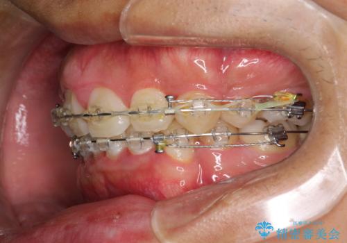 ワイヤー矯正終了時に装置除去と合わせてPMTCの治療前