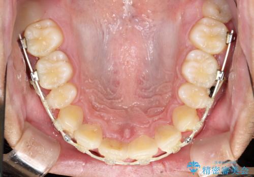 ワイヤー矯正終了時に装置除去と合わせてPMTCの治療前