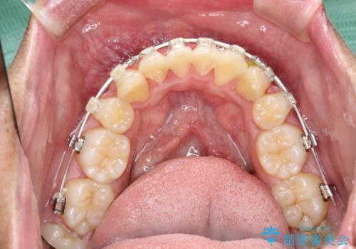 ワイヤー矯正終了時に装置除去と合わせてPMTCの治療前
