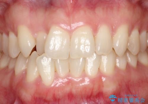 【ホワイトニング】矯正前に歯を白くしたいの症例 治療前