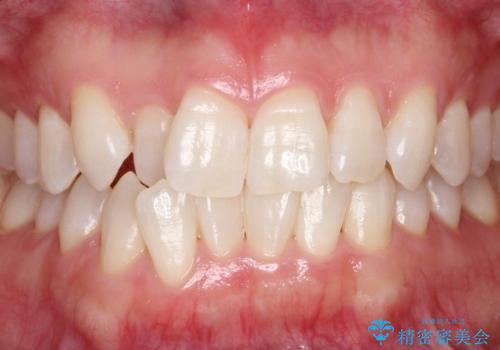 【ホワイトニング】矯正前に歯を白くしたいの症例 治療後