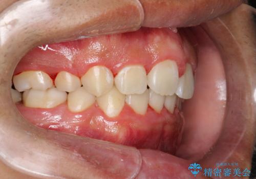 ワイヤー矯正終了時に装置除去と合わせてPMTCの治療後