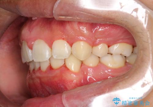 ワイヤー矯正終了時に装置除去と合わせてPMTCの治療後