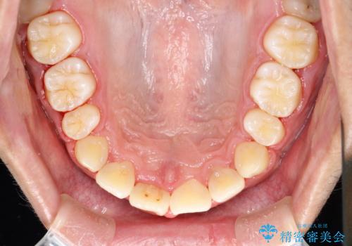 ワイヤー矯正終了時に装置除去と合わせてPMTCの治療後