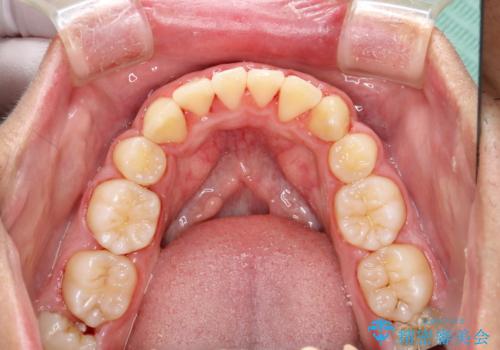 ワイヤー矯正終了時に装置除去と合わせてPMTCの治療後