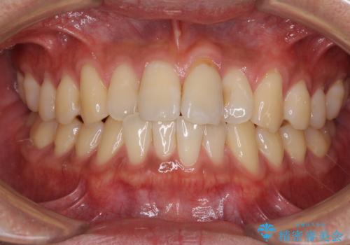 気になる前歯のデコボコをインビザラインで解消の症例 治療前