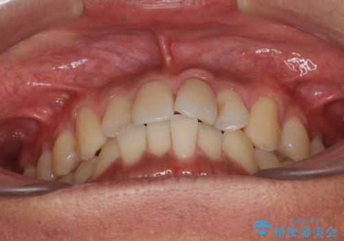 気になる前歯のデコボコをインビザラインで解消の治療前