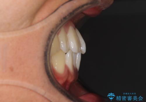 気になる前歯のデコボコをインビザラインで解消の治療前