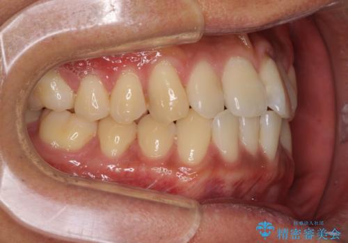 気になる前歯のデコボコをインビザラインで解消の治療前