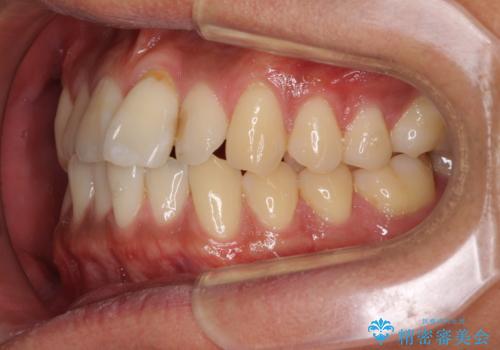 気になる前歯のデコボコをインビザラインで解消の治療前