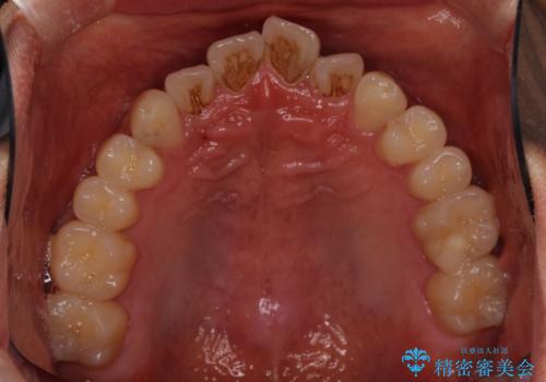 気になる前歯のデコボコをインビザラインで解消の治療前