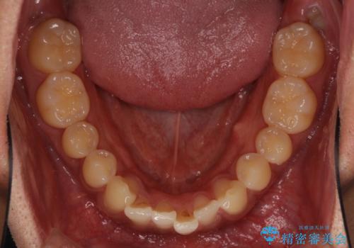 気になる前歯のデコボコをインビザラインで解消の治療前