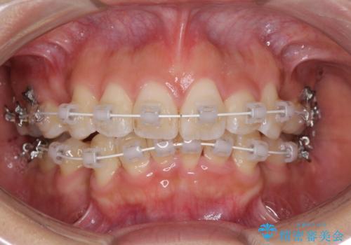 スッキリとした口元へ 出っ歯の抜歯矯正の治療中