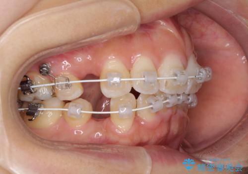 スッキリとした口元へ 出っ歯の抜歯矯正の治療中