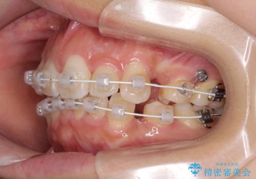 スッキリとした口元へ 出っ歯の抜歯矯正の治療中