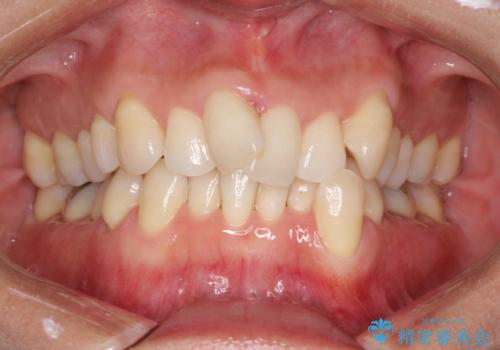 重度のガタガタのインビザラインによる非抜歯矯正の症例 治療前