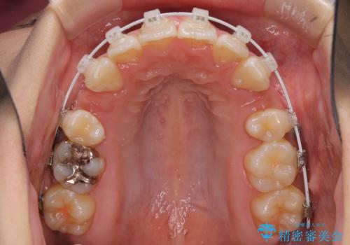 スッキリとした口元へ 出っ歯の抜歯矯正の治療中