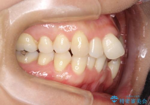 重度のガタガタのインビザラインによる非抜歯矯正の治療前
