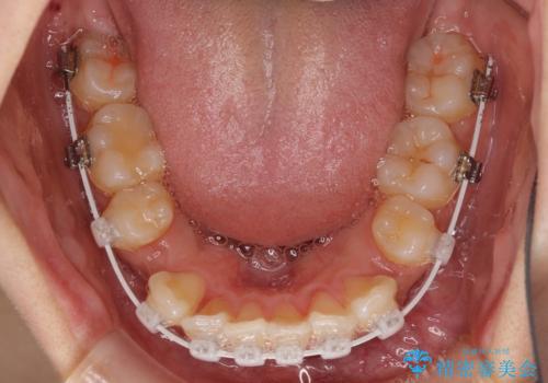 スッキリとした口元へ 出っ歯の抜歯矯正の治療中