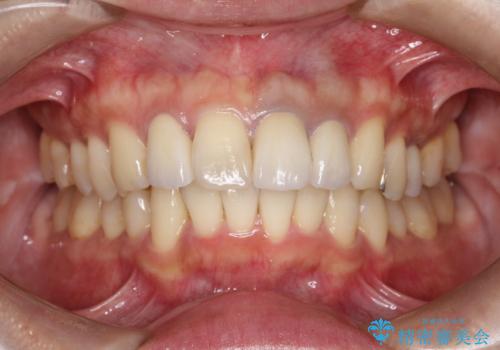 歯並びを含めて前歯をきれいにしたい インビザラインとセラミック治療の症例 治療後