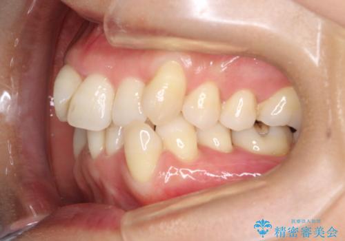 重度のガタガタのインビザラインによる非抜歯矯正の治療前