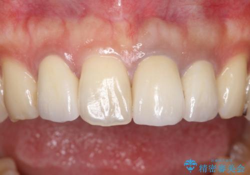 歯並びを含めて前歯をきれいにしたい インビザラインとセラミック治療の治療後