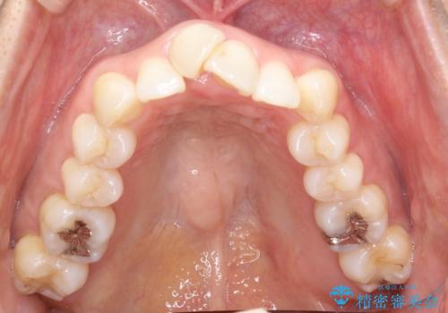 重度のガタガタのインビザラインによる非抜歯矯正の治療前