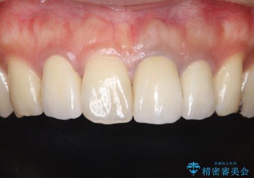 歯並びを含めて前歯をきれいにしたい インビザラインとセラミック治療の治療後