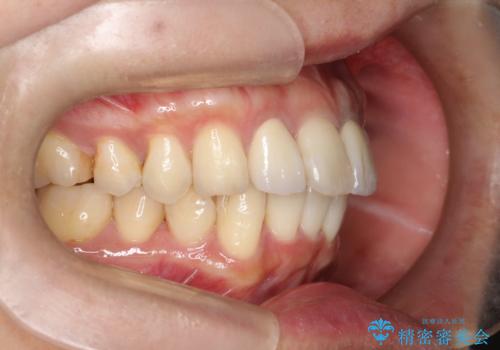 歯並びを含めて前歯をきれいにしたい　インビザラインとセラミック治療の治療後