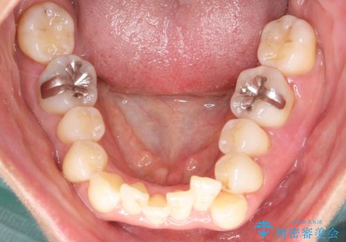 重度のガタガタのインビザラインによる非抜歯矯正の治療前