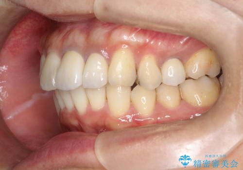 歯並びを含めて前歯をきれいにしたい インビザラインとセラミック治療の治療後