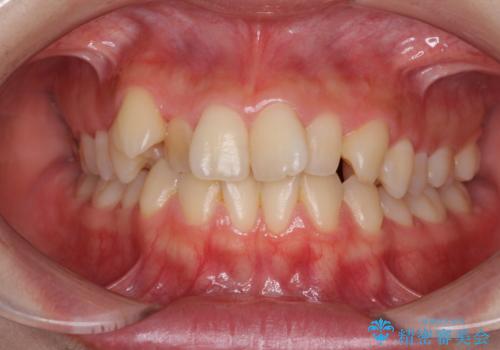 前歯2本が欠損　抜歯矯正でデコボコを治すの症例 治療前