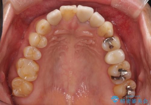 歯並びを含めて前歯をきれいにしたい インビザラインとセラミック治療の治療後