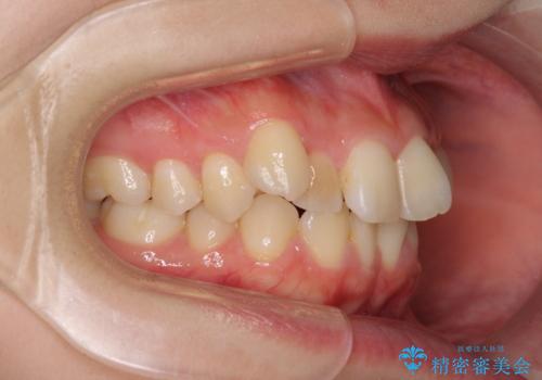 前歯2本が欠損　抜歯矯正でデコボコを治すの治療前