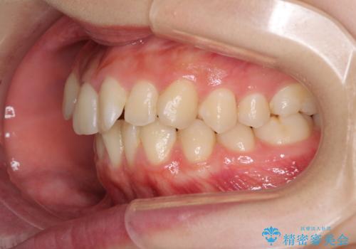 前歯2本が欠損　抜歯矯正でデコボコを治すの治療前