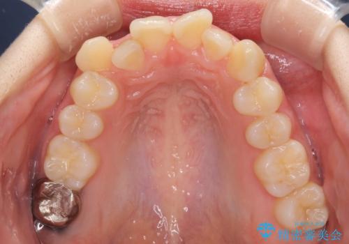 前歯2本が欠損　抜歯矯正でデコボコを治すの治療前