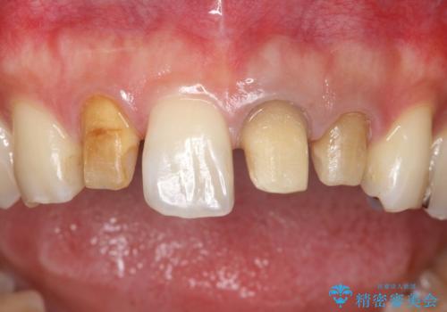 歯並びを含めて前歯をきれいにしたい インビザラインとセラミック治療の治療中