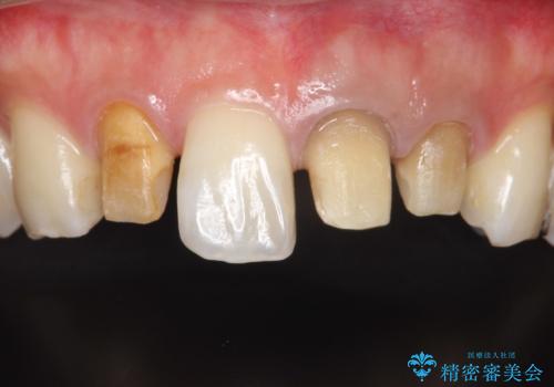 歯並びを含めて前歯をきれいにしたい インビザラインとセラミック治療の治療中