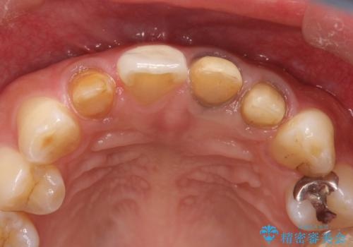 歯並びを含めて前歯をきれいにしたい インビザラインとセラミック治療の治療中