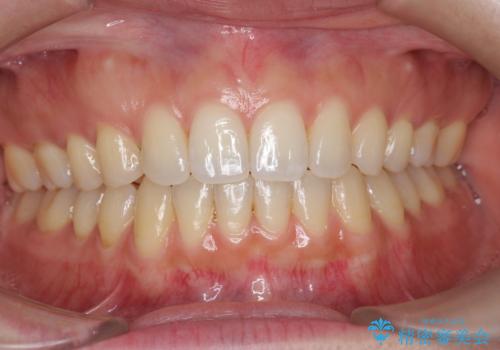 オフィスホワイトニングで、白い歯に!の症例 治療前