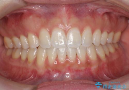 オフィスホワイトニングで、白い歯に!の症例 治療後