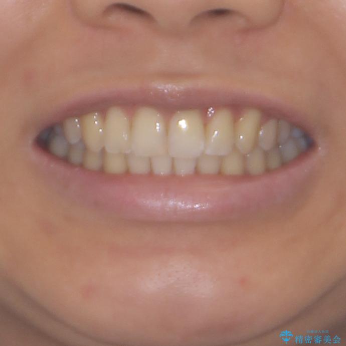 インビザラインによる矯正治療　カリエールディスタライザーを用いた奥歯の咬み合わせ改善の治療後（顔貌）