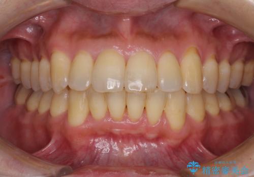前歯のデコボコ　ワイヤー装置での短期間治療