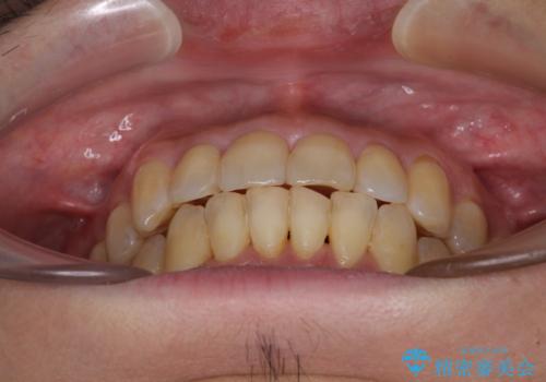 前歯のデコボコ ワイヤー装置での短期間治療の治療後