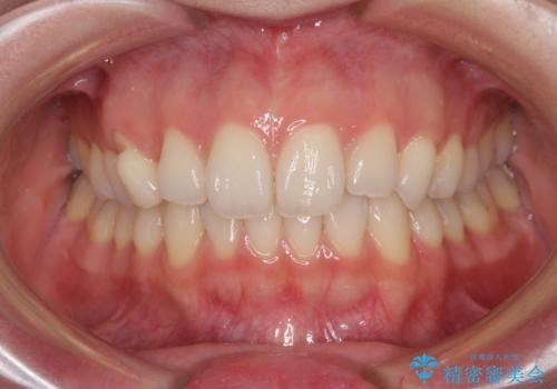 狭い上顎骨を拡大 急速拡大装置を併用したインビザライン矯正の治療中