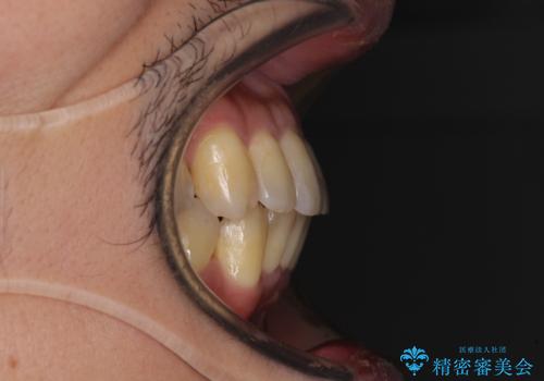 前歯のデコボコ ワイヤー装置での短期間治療の治療後