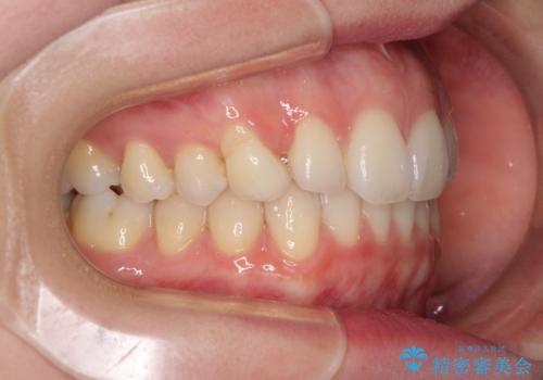 狭い上顎骨を拡大 急速拡大装置を併用したインビザライン矯正の治療中