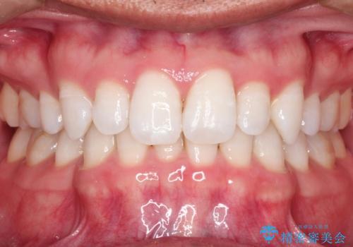 【インビザライン】笑った時の歯並びを綺麗にしたいの症例 治療前